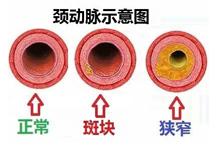 【脑科科普】1/3中国成人有颈动脉粥样硬化,没症状≠没危险